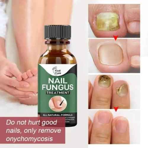 Nail Fungus Treatment Serum 10ml – Fast & Effective Fungal Solution
