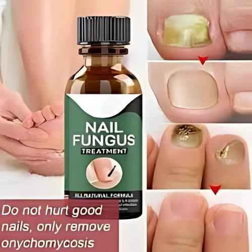 Nail Fungus Treatment Serum 10ml – Fast & Effective Fungal Solution