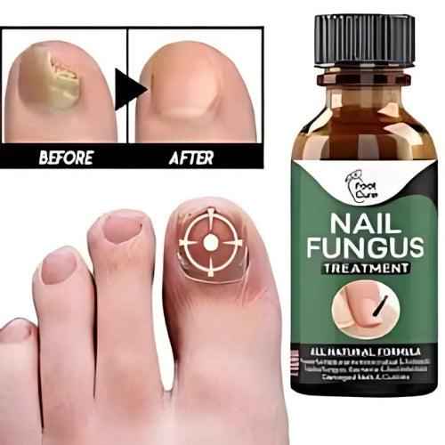 Nail Fungus Treatment Serum 10ml – Fast & Effective Fungal Solution