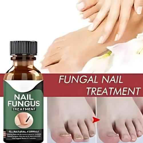 Nail Fungus Treatment Serum 10ml – Fast & Effective Fungal Solution