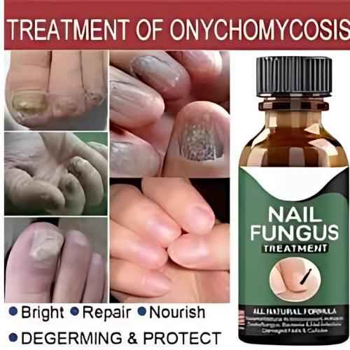 Nail Fungus Treatment Serum 10ml – Fast & Effective Fungal Solution